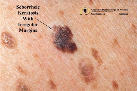 Seborrheic Keratosis Atypical Forms Academic Dermatology Of Nevada