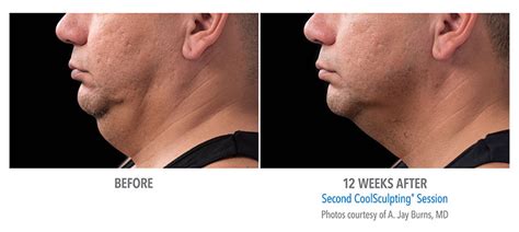 Coolsculpting Chin Before And After Double Chin Fat Freezing Near Me Uk