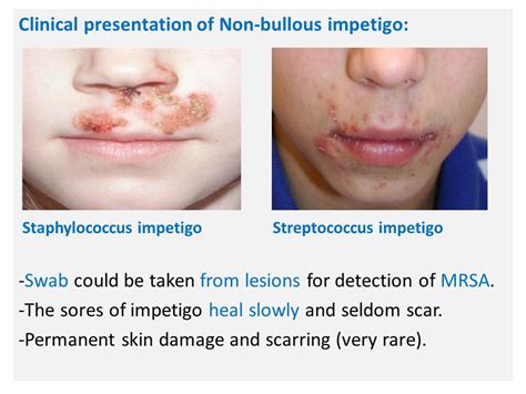 Skin And Soft Tissue Infections Impetigo Impetigo Is Superficial