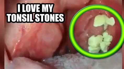 I Love Popping Tonsil Stones What Are Tonsil Stones Youtube