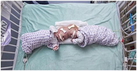 Formerly Conjoined Twins Are “thriving” After Being Separated In An 11