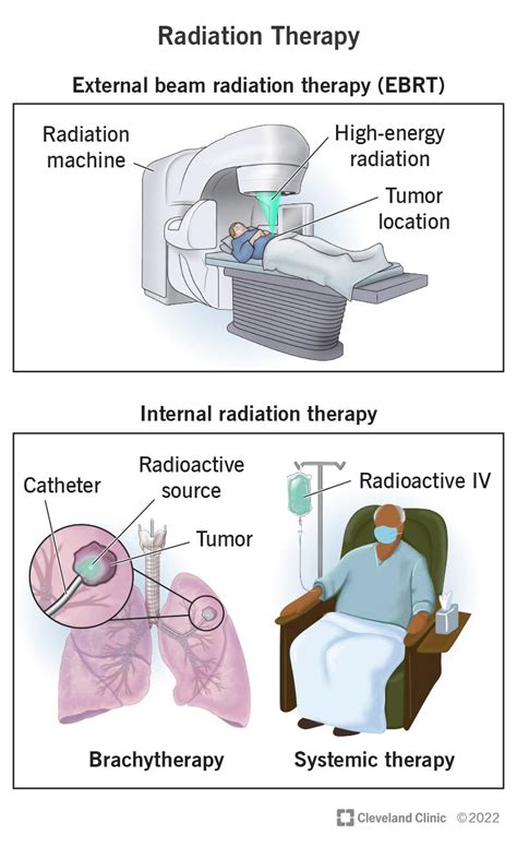 Radiation Therapy For Cancer How Does It Work