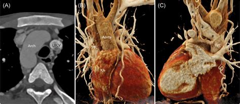 Axial Ct Angiography Image A Shows Presence Of Right‐sided Aortic