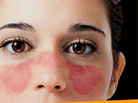 Lupus 5 Ways Lupus Affects The Eyes Some Apps Also Keep Track Of