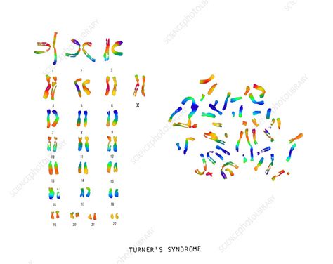 Turner S Syndrome Karyotype Stock Image C022 0559 Science Photo