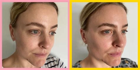 Profhilo Before And After Photos Australia Bio Remodelling Filler