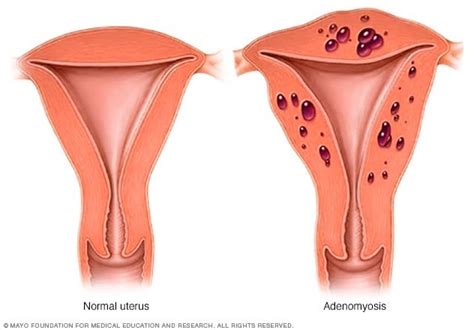 Adenomyosis Symptoms And Causes Mayo Clinic