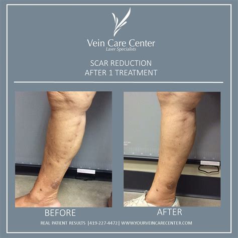 Scar Removal Before And After Lima Oh Vein Care Center