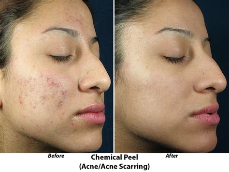 Acne Before And After Botox Before And After Reston Va