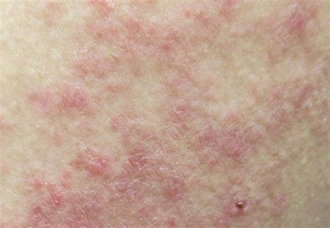 Lupus Dermatitis Pictures Dermatitis Rash Pictures Neurodermatitis