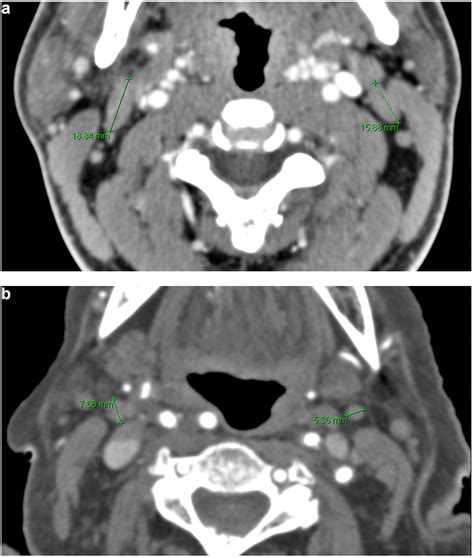Jugulodigastric Lymph Node Size By Age On Ct In An Adult Cancer Free