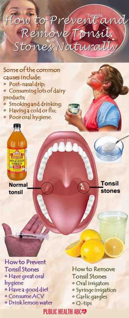 When should i seek immediate care? Food Stuck In Tonsillectomy Blocked Ears Throat Sore Nose ...