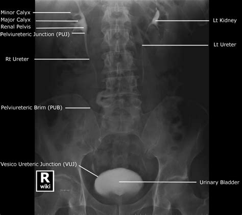 Labeled Abdominal X Ray