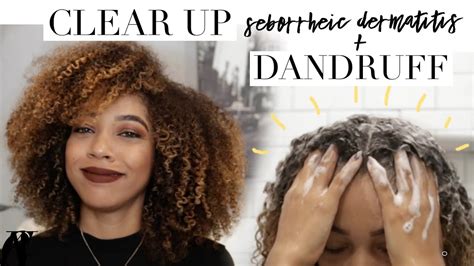 Seborrheic Dermatitis Scalp African American Hair