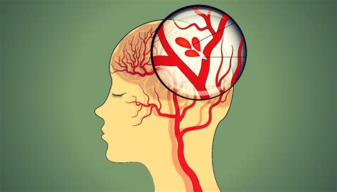 S Ntomas Silenciosos De Un Accidente Cerebrovascular Que Debes Conocer