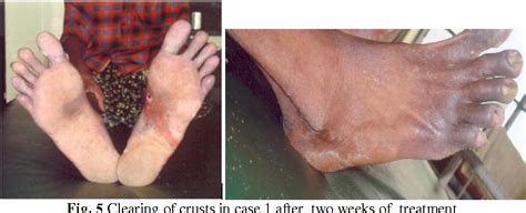 Figure 1 From Crusted Norwegian Scabies Two Case Reports With Hiv