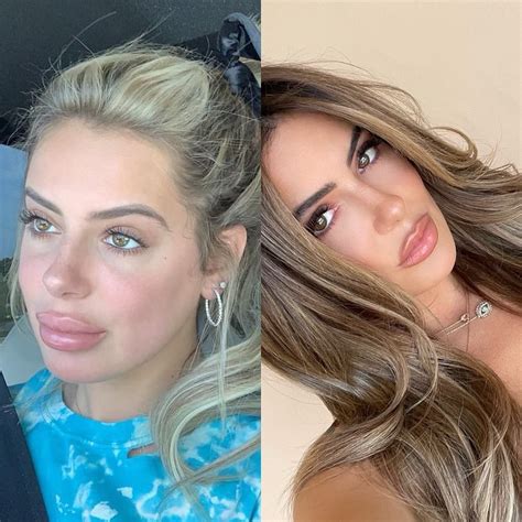 Brielle Biermann Warns Against Getting Lips ‘overfilled’ With Shocking Before And After Photos