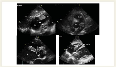 Cases Of Right Sided Infective Endocarditis See Text For Details Ao