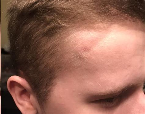 Post Tbi Newly Formed Dentcrevice On Forehead Headway