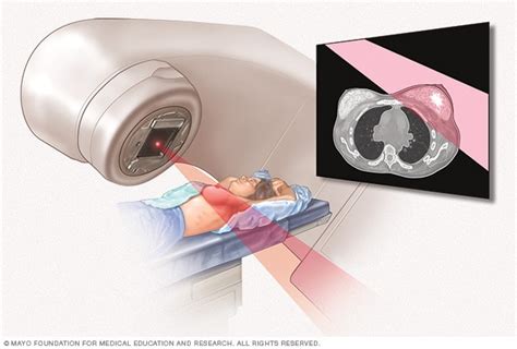 Radiation Therapy For Breast Cancer Mayo Clinic