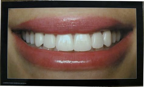 Ideal Smile Poster Los Angeles Institute Of Clinical Dentistry And Ruiz