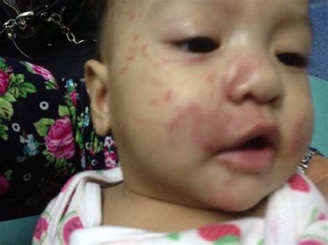Muka Bayi 5 Bulan Cedera Digigit Dicakar Dalam Jagaan Pengasuh 3