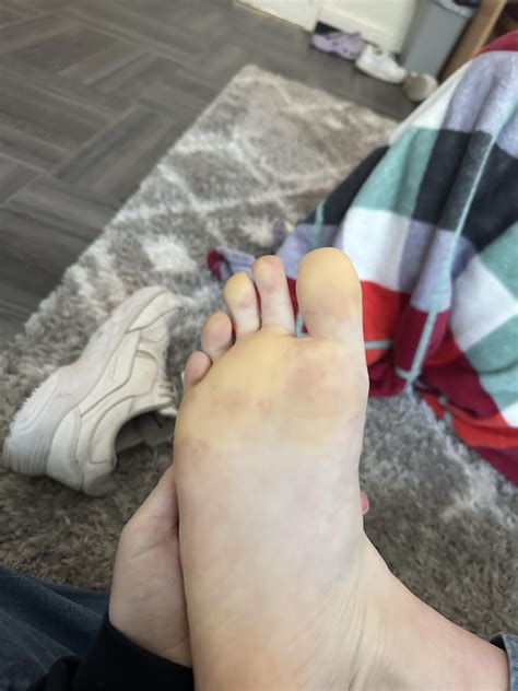Numbness And Discoloration In Feettoes When Cold Rmedicaladvice