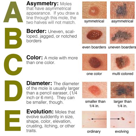 Melanoma Abcde Signs Vector Illustration Of Skin Patch With Skin My