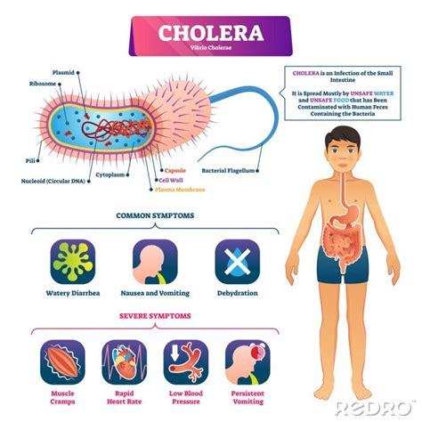 Plakat Cholera Vector Illustration Labeled Infection Structure And Na