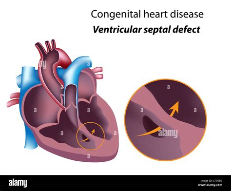 Enfermedad Del Corazón Congénita Defecto Septal Ventricular Fotografía