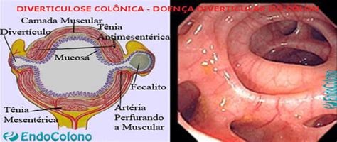 Doença Diverticular Colonoscopia Em Belo Horizonte