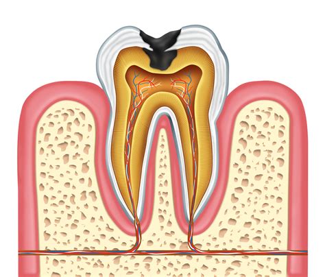 Everything You Should Know About Dental Cavities Top Dental