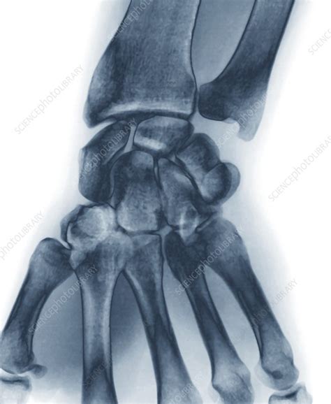 Normal Wrist X Ray Stock Image F0039170 Science Photo Library