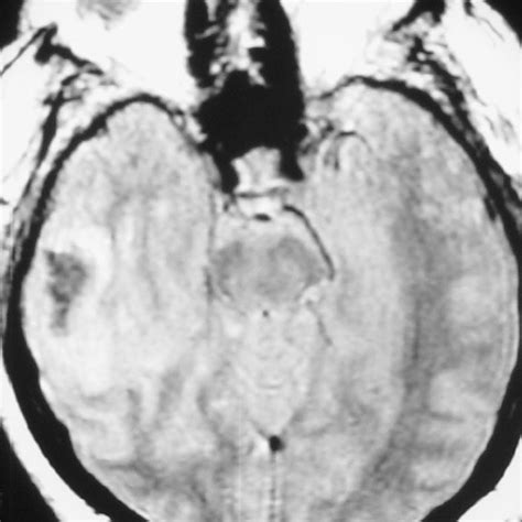 Pdf Isolated Right Temporal Lobe Stroke Patients Present With Geschwind Gastaut Syndrome