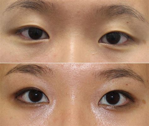 Expert In Asian Double Eyelid Surgery Nyc
