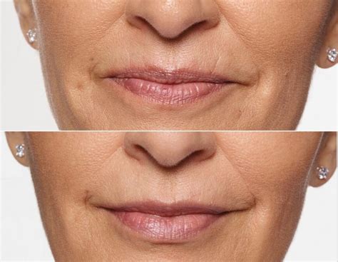 Restylane Silk Lip Filler Before And After Vein And Laser Institute