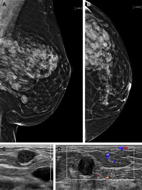 Implementation Of Whole Breast Screening Ultrasonography Radiologic