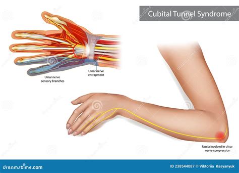 Cubital Tunnel Syndrome The Ulnar Nerve Originates Fr