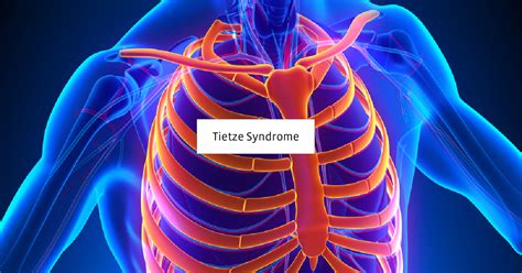 Tietze Syndrome What Is It Symptoms Diagnosis Treatment And Exercises