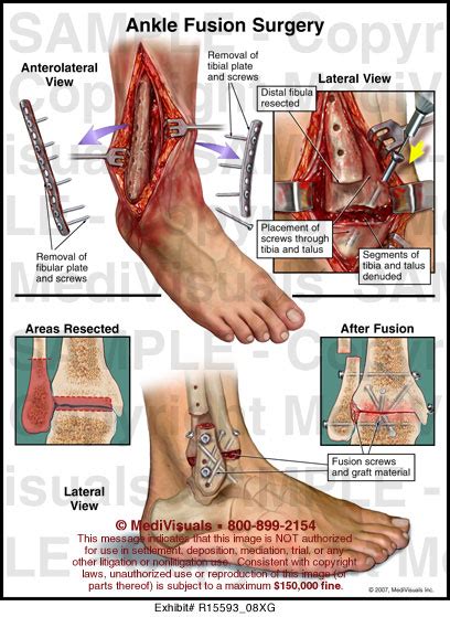 Ankle Fusion Surgery Medivisuals Medical Illustration