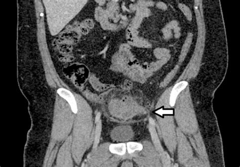 Diagnostic Imaging Of Acute Abdominal Pain In Adults