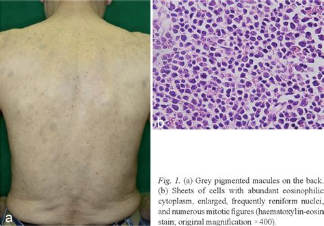 Figure 1 From Cutaneous Myeloid Sarcoma Presenting As Grey Pigmented