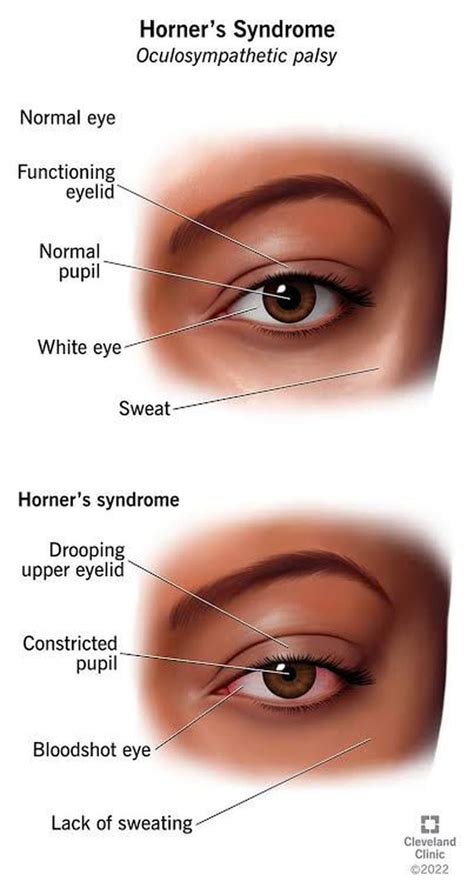 Symptoms Of Horner Syndrome Medizzy