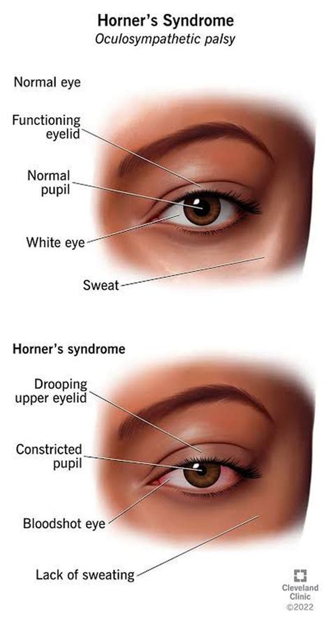 Symptoms Of Horner Syndrome MEDizzy