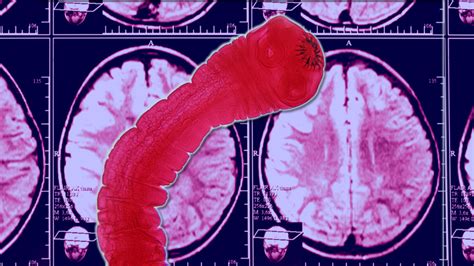 Doctors Shocked After Finding Tapeworm In Mans Brain Abc7 Los Angeles