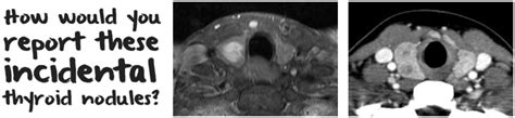 Reporting Of Incidental Thyroid Nodules On Ct And Mri Radiology Blog