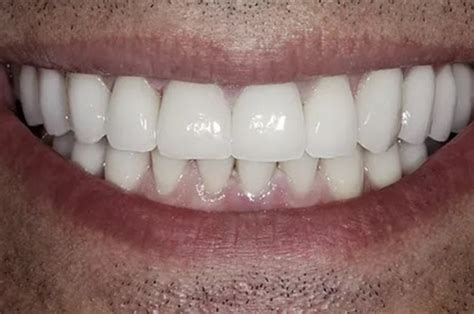 Lowenberg Lituchy Kantor NY Cosmetic Dentists Lengthen Worn Teeth