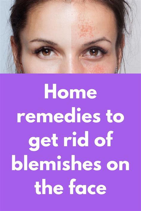 Home Remedies To Get Rid Of Blemishes On The Face Blemishes On Face