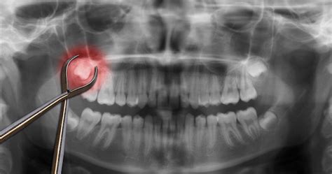 Types Of Wisdom Tooth Impactions Sedaros Oral Surgery