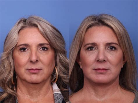 Facelift Before And After Pictures Case 457 Scottsdale Az Hobgood Facial Plastic Surgery